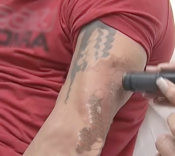 togliere il tatuaggio definitivamente  con il laser 