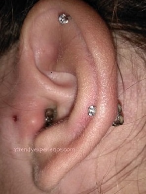 infezione trago orecchino nella cartilagine