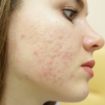 trattamento delle cicatrici da acne