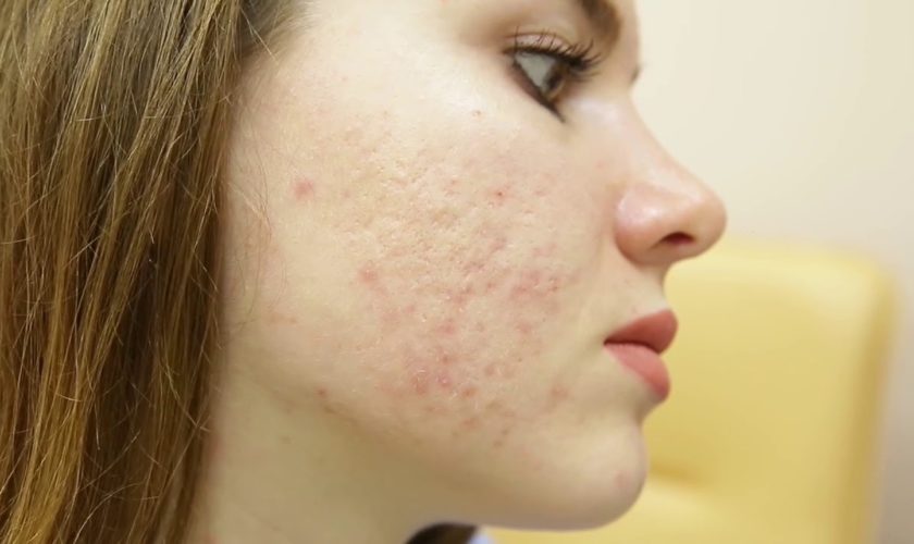trattamento delle cicatrici da acne