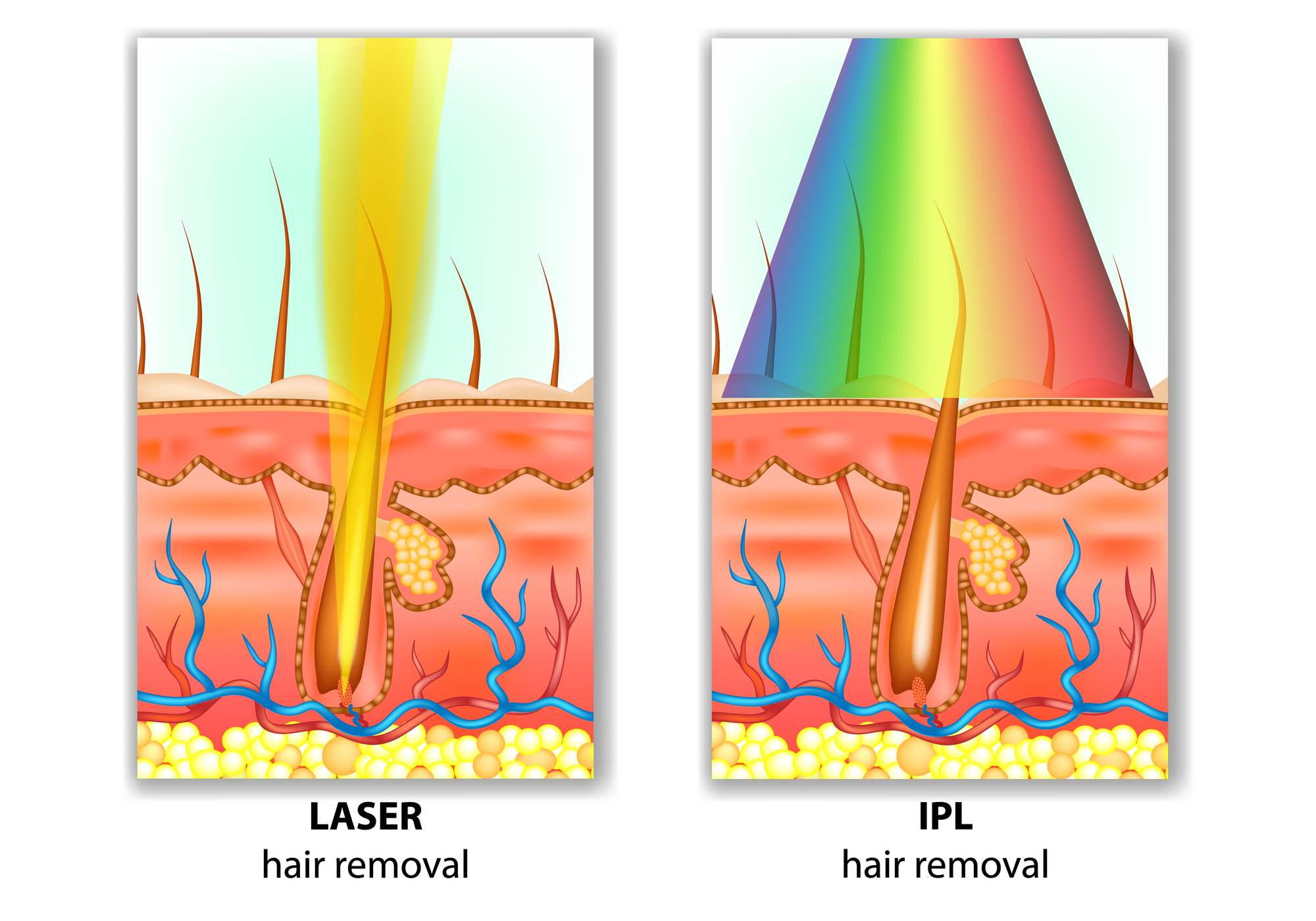 Luce pulsata e laser: le principali differenze